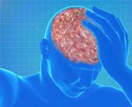Субарахноидальное кровоизлияние в мозг: последствия, симптомы и лечение Субарахноидальное кровоизлияние последствия лечение